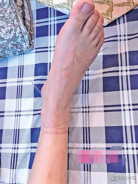 无痛通乳 黄帝内针显疗效